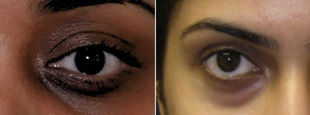 Under-Eye